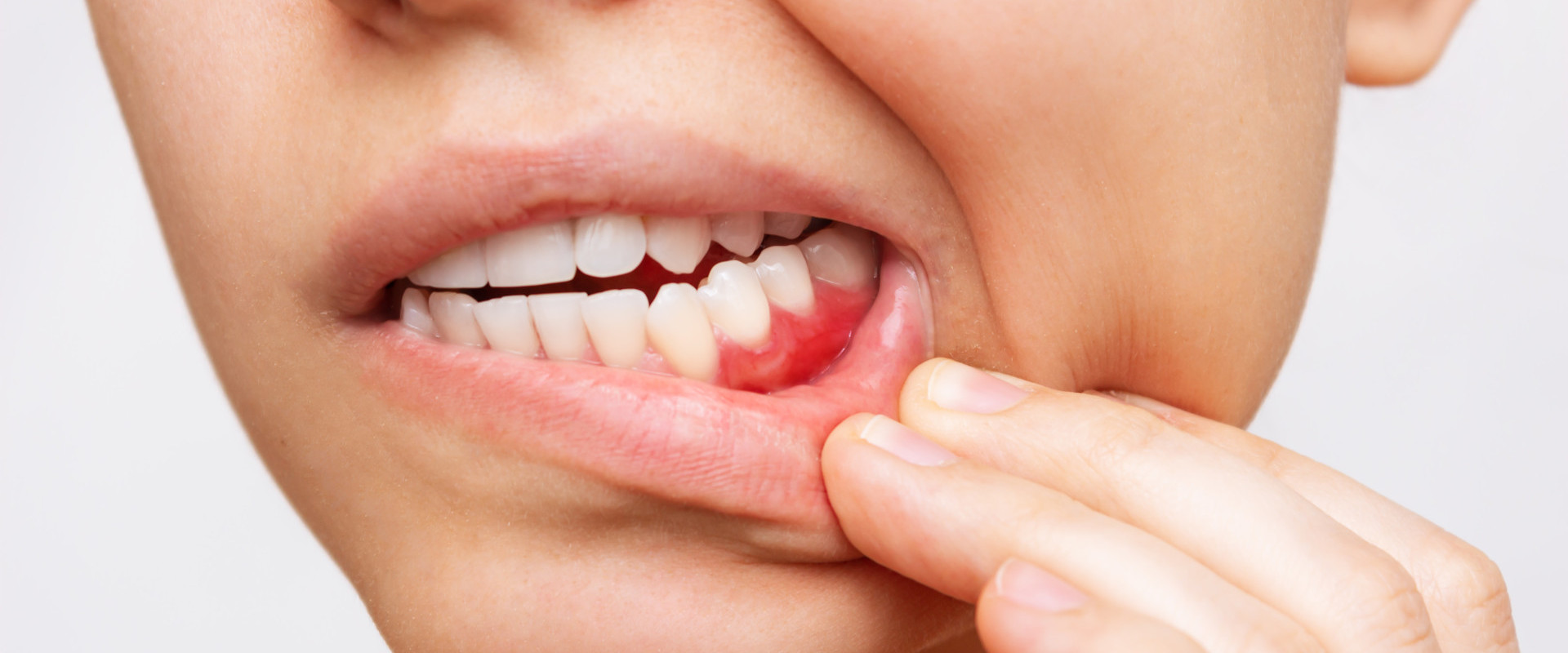 Entzündetes Zahnfleisch